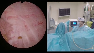 En bloc резекция стенки мочевого пузыря с опухолью с последующей инцизией предстательной железы